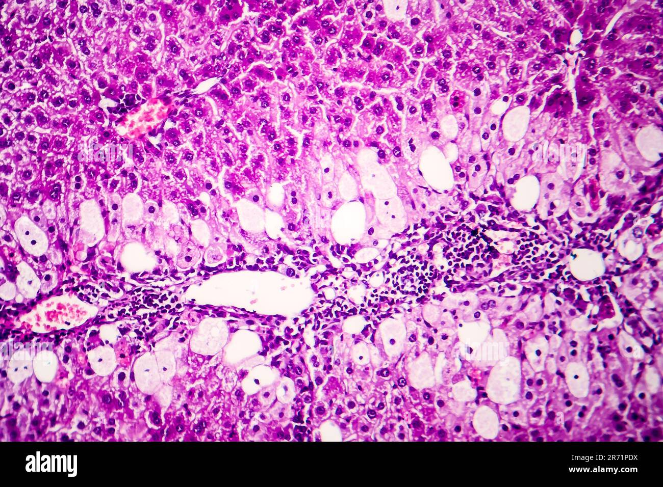 Histopathologie de l'hépatite aiguë, micrographe léger, photo sous microscope Banque D'Images
