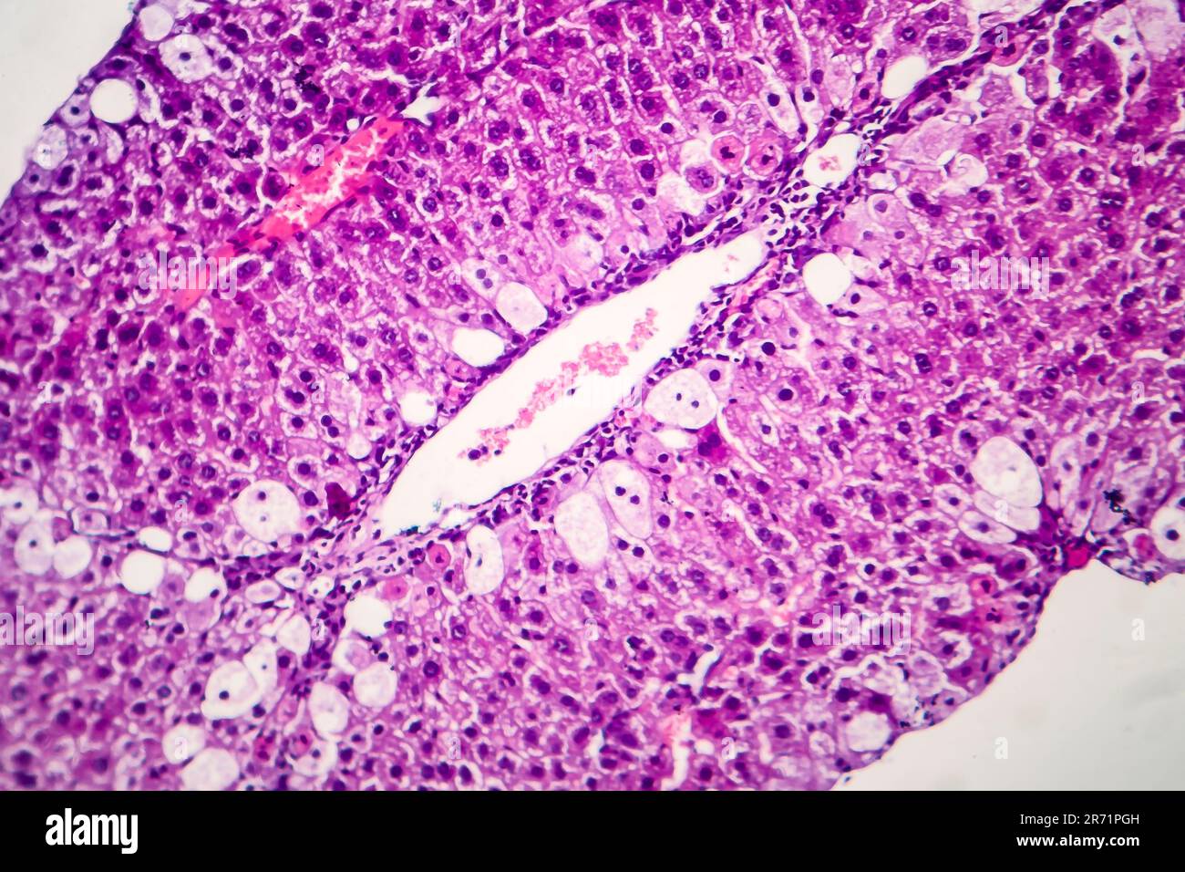 Histopathologie de l'hépatite aiguë, micrographe léger, photo sous microscope Banque D'Images