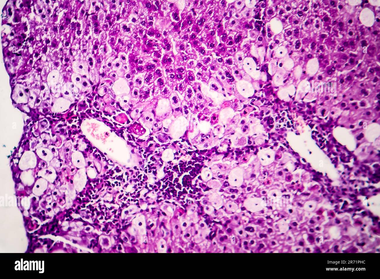 Histopathologie de l'hépatite aiguë, micrographe léger, photo sous microscope Banque D'Images