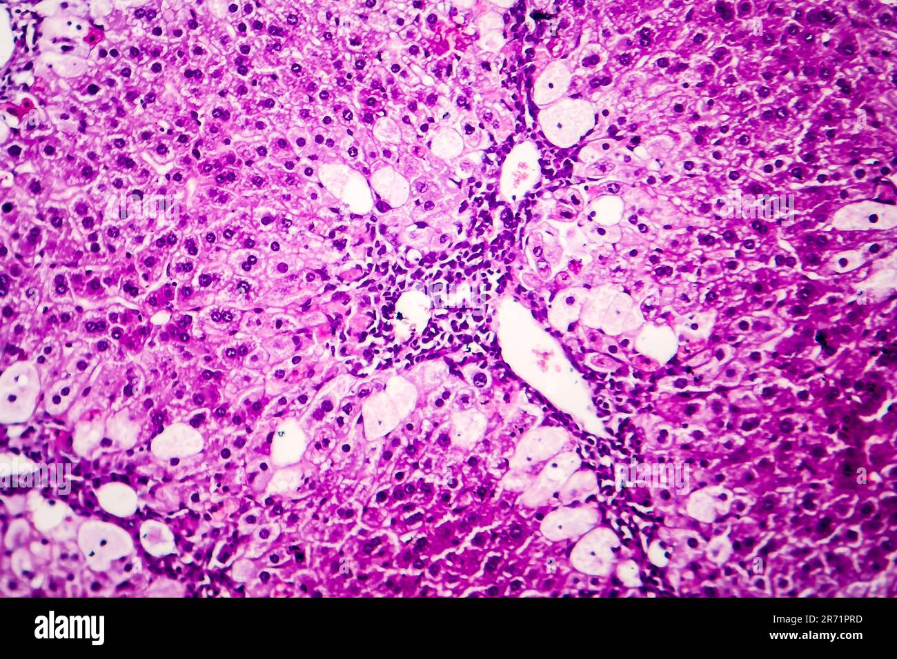 Histopathologie de l'hépatite aiguë, micrographe léger, photo sous microscope Banque D'Images