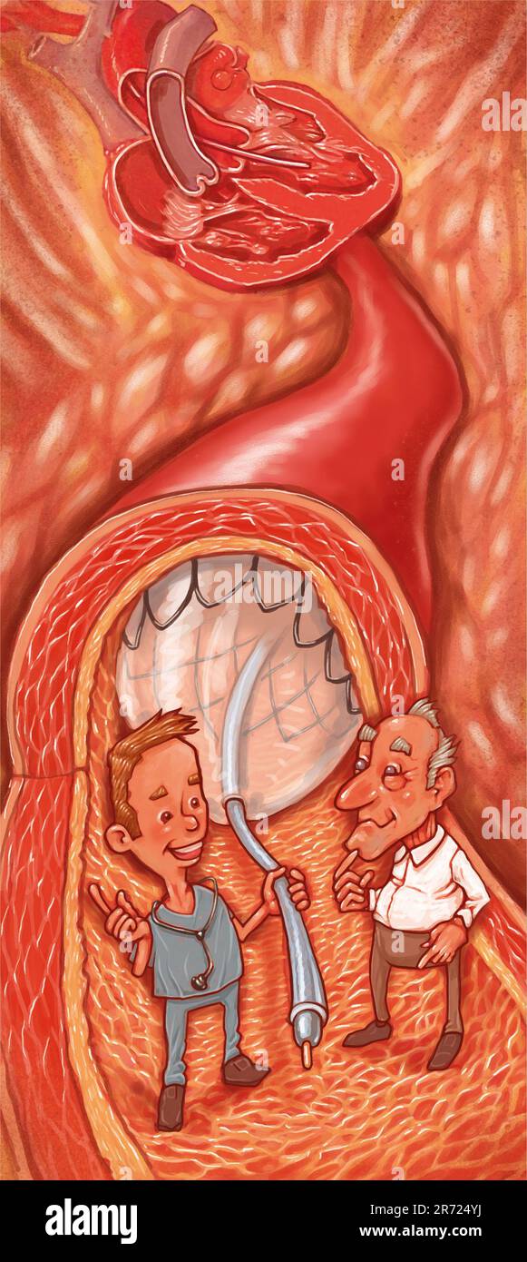 Concept art illustrant la procédure médicale diagnostique cathétérisme cardiaque, tube fin et