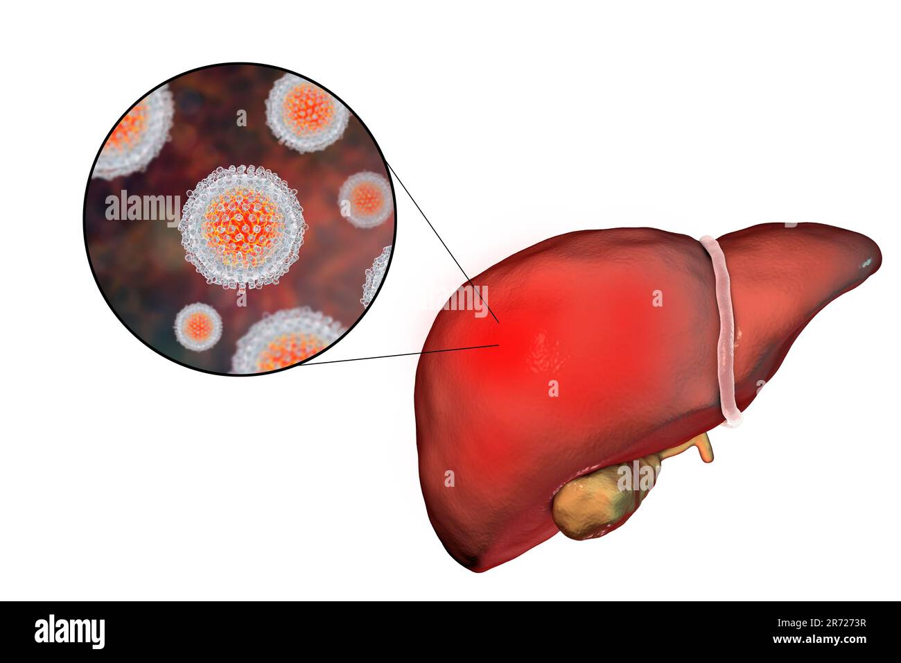 Infection virale de l'hépatite C au stade de la cirrhose du foie. Illustration de l'ordinateur montrant le foie cirrhotique et une vue rapprochée des virus de l'hépatite C. H Banque D'Images