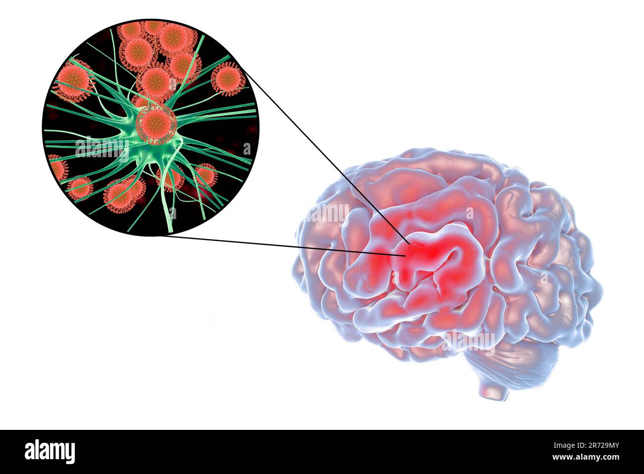 Encéphalite virale. Image conceptuelle montrant le cerveau et une vue rapprochée des virus infectant les neurones. Banque D'Images