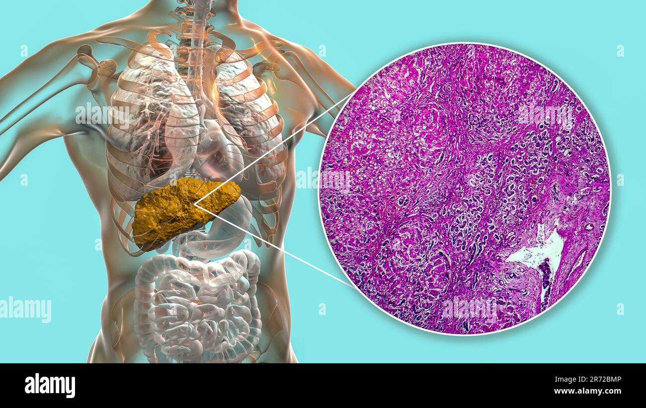 Cirrhose du foie, illustration informatique et micrographe léger d'une section à travers un foie humain souffrant de cirrhose biliaire primitive. La cirrhose est Banque D'Images