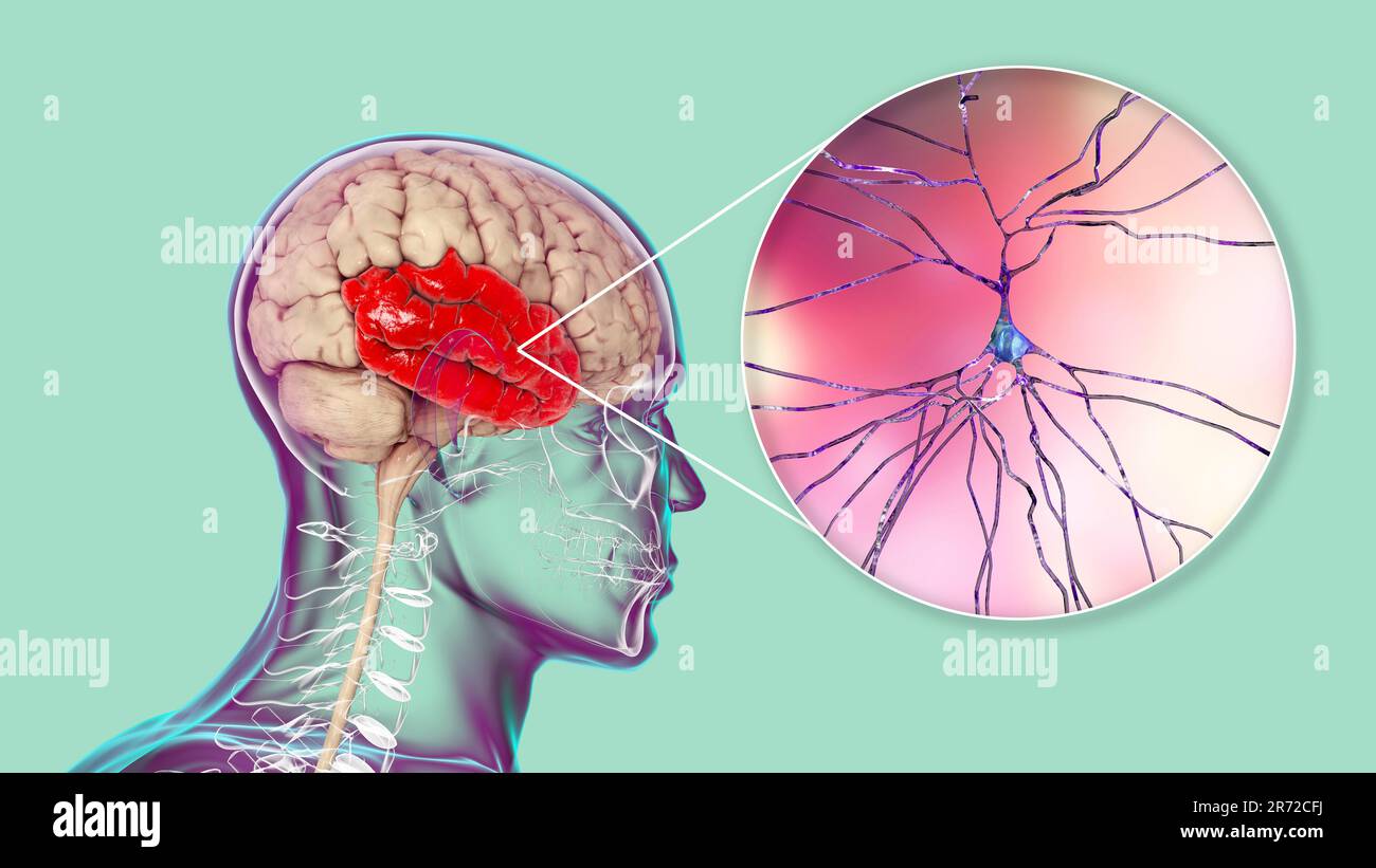 Cerveau humain avec lobe temporal mis en évidence et vue rapprochée des neurones situés dans le lobe temporal, illustration informatique. Banque D'Images