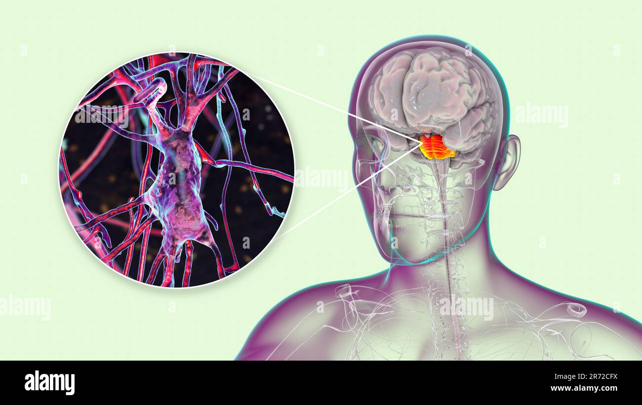 Cerveau humain avec des pons et des neurones mis en évidence, illustration. Cerveau humain avec des pons mis en évidence Varolii et vue rapprochée des neurones pyramidaux (nerf c Banque D'Images
