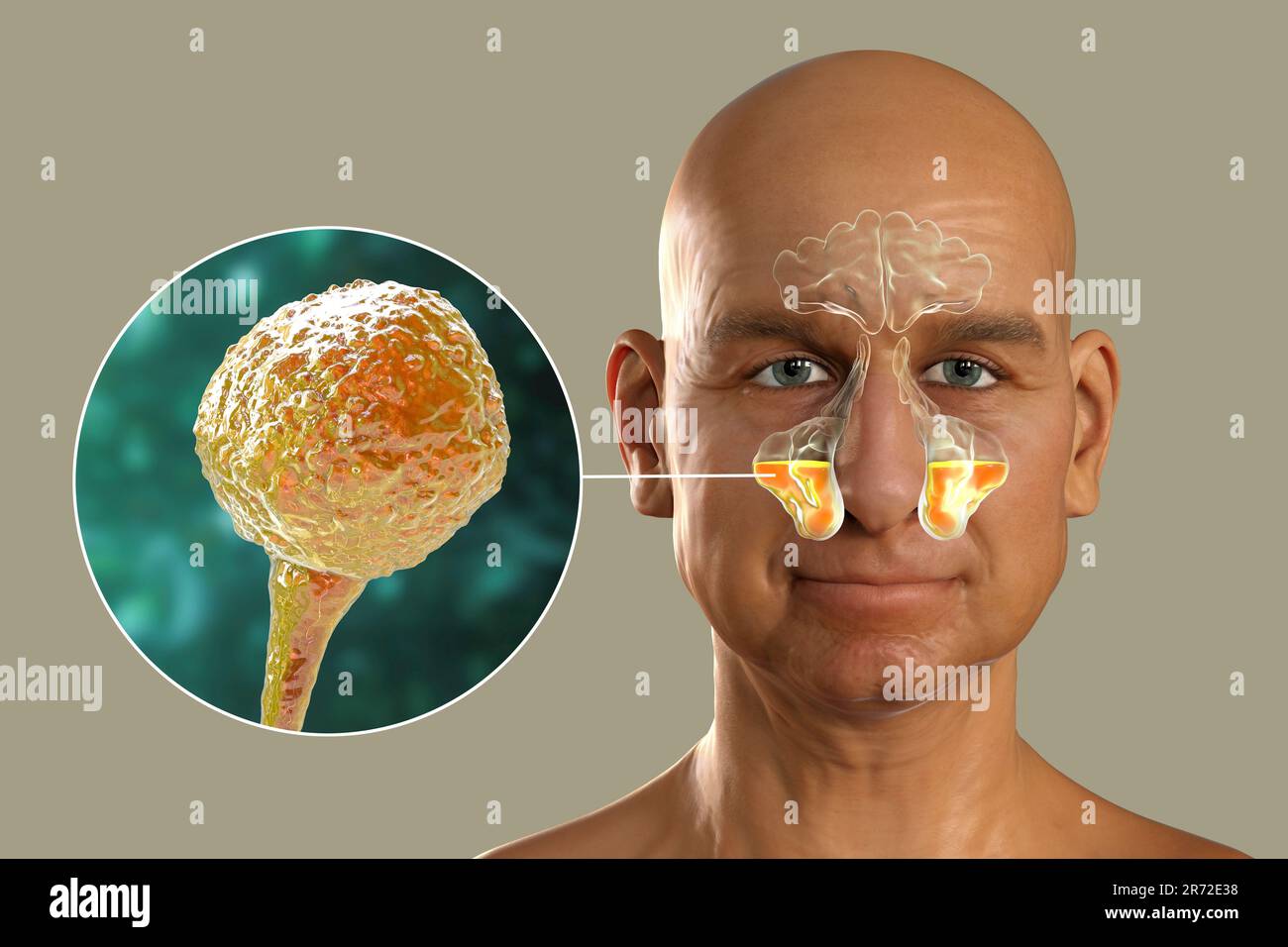 Champignons de Mucor comme cause de sinusite, illustration informatique. Inflammation des sinus maxillaires et vue rapprochée des champignons Mucor, également connu sous le nom de fu noir Banque D'Images