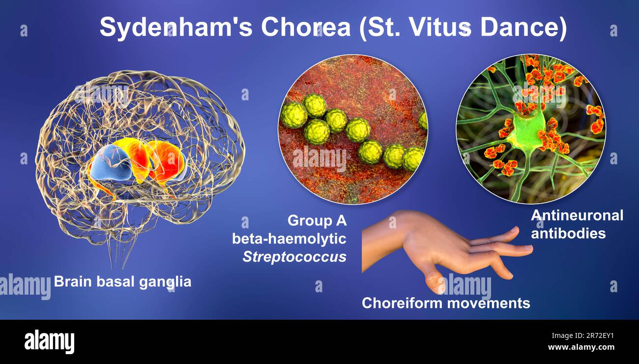 La chorée de Sydenham, une maladie auto-immune qui résulte de l'infection à Streptococcus, la formation d'anticorps anti-neuronaux endommageant les ganglions basaux du cerveau Banque D'Images