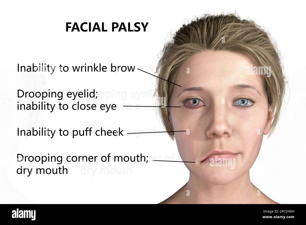 Paralysie de Bell, paralysie faciale unilatérale, illustration informatique. La condition est due à l'inflammation du nerf facial. Il provoque le dro facial Banque D'Images