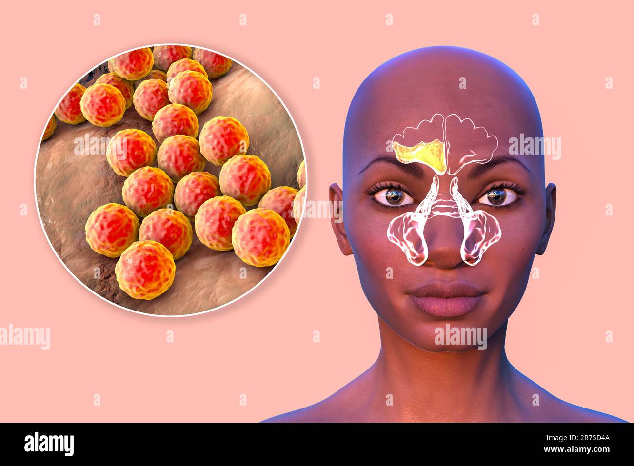 Les bactéries Staphylococcus aureus comme cause de sinusite. Illustration informatique montrant une inflammation du sinus frontal et une vue rapprochée du staphylococca Banque D'Images