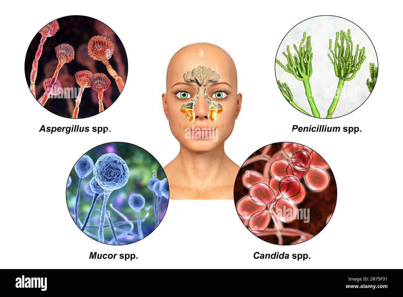 Les champignons comme cause de sinusite. Illustration informatique montrant l'inflammation des sinus maxillaires et des champignons Aspergillus, Penicillium, Mucor et Candida. Banque D'Images