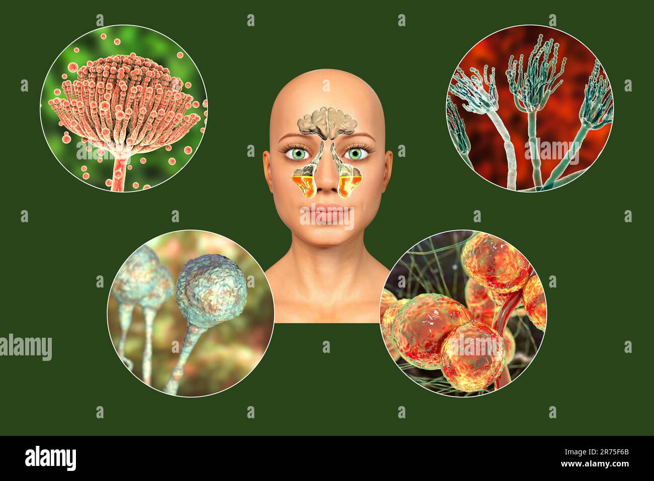 Les champignons comme cause de sinusite. Illustration informatique ...