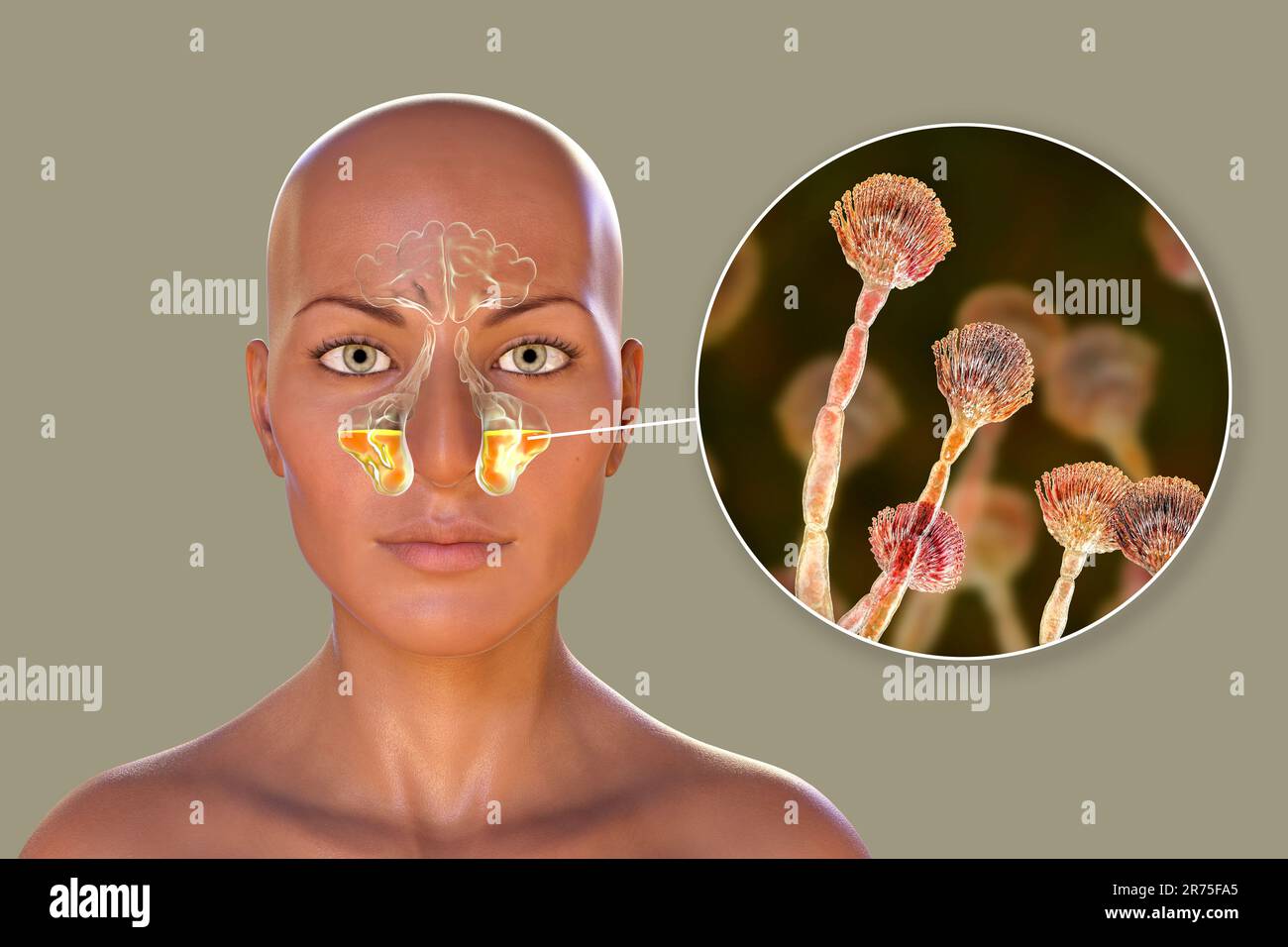 Aspergillus champignons comme une cause de sinusite. Illustration informatique montrant l'inflammation des sinus maxillaires et vue rapprochée du champignon Aspergillus. C Banque D'Images