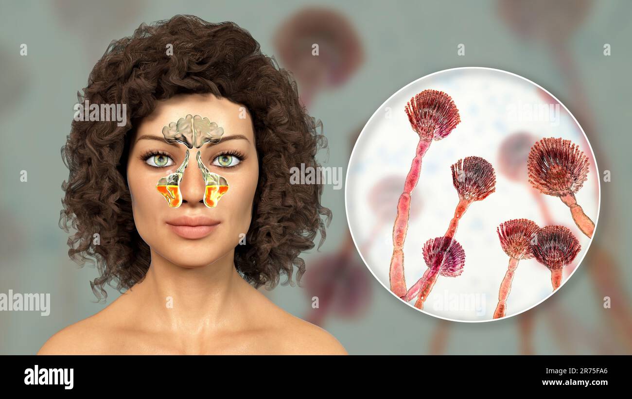 Aspergillus champignons comme une cause de sinusite. Illustration informatique montrant l'inflammation des sinus maxillaires et vue rapprochée du champignon Aspergillus. C Banque D'Images