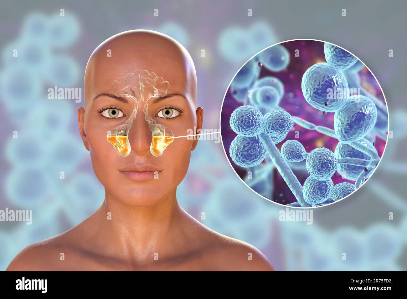 Les champignons de levure de Candida comme cause de sinusite. Illustration informatique montrant l'inflammation des sinus maxillaires et vue rapprochée des champignons de Candida. Banque D'Images