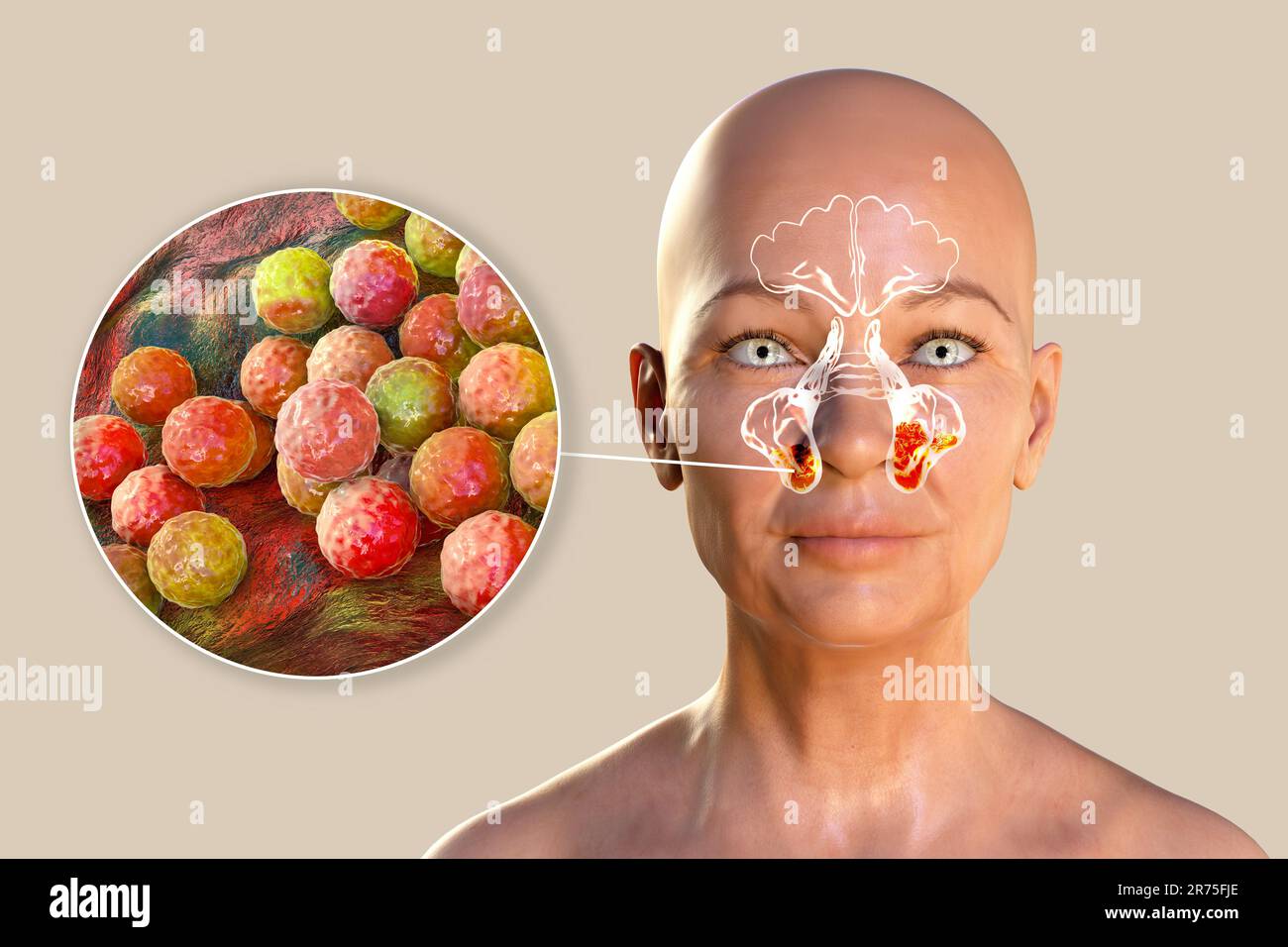 Les bactéries Staphylococcus aureus comme cause de sinusite. Illustration informatique montrant une inflammation des sinus maxillaires et une vue rapprochée du staphyloc Banque D'Images