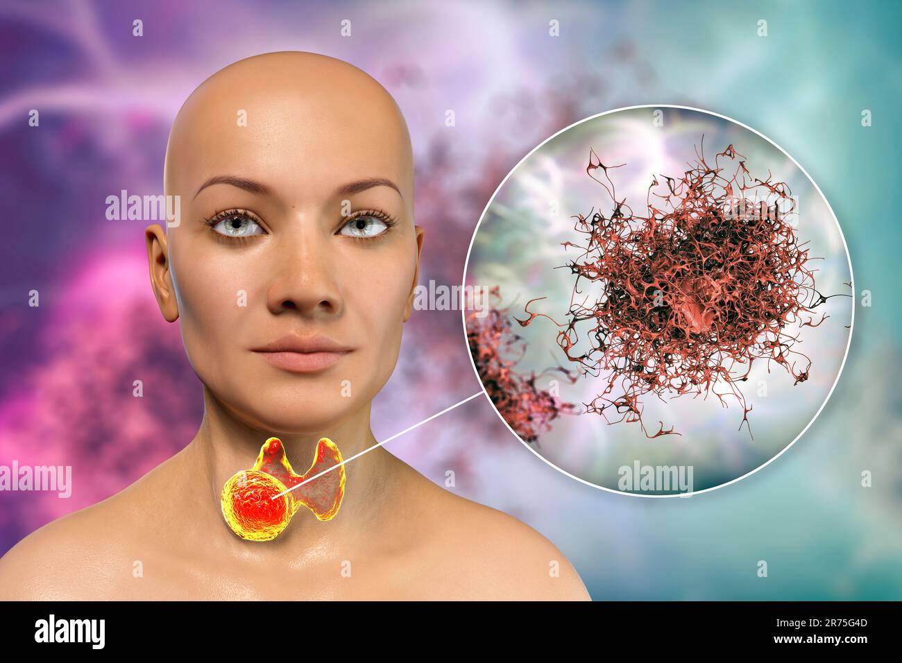Cancer de la glande thyroïde avec vue rapprochée des cellules