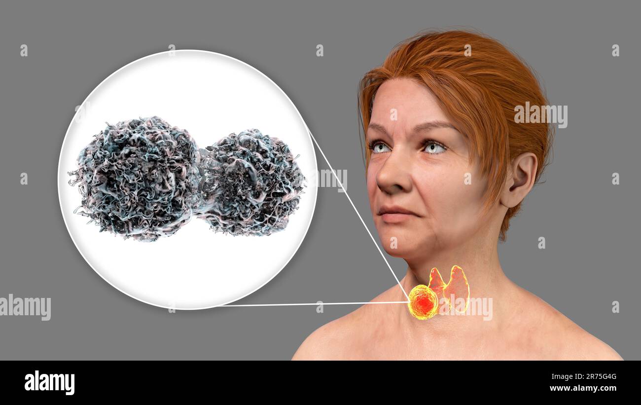 Cancer de la glande thyroïde avec vue rapprochée des cellules