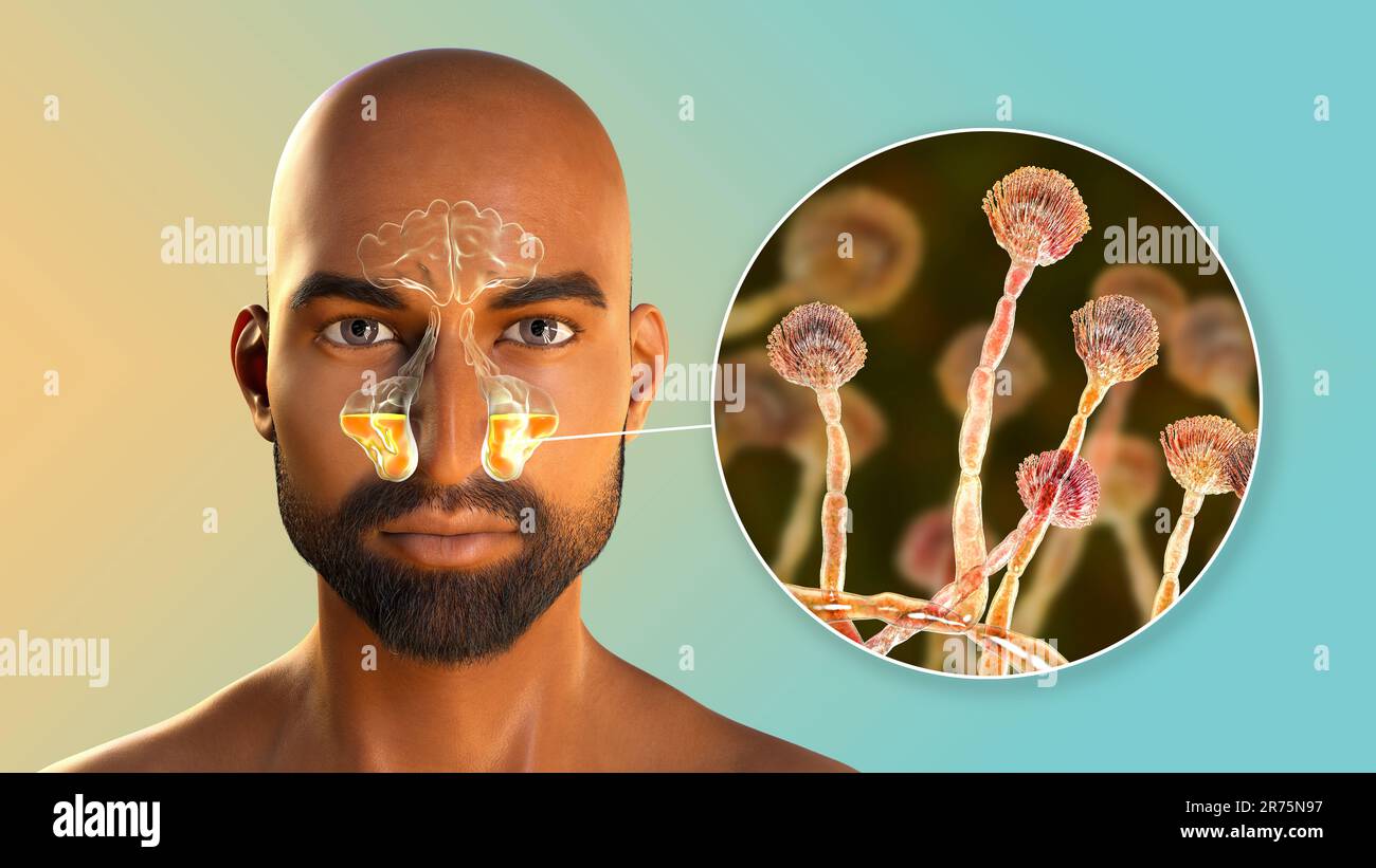 Aspergillus champignons comme une cause de sinusite. Illustration informatique montrant l'inflammation des sinus maxillaires et vue rapprochée du champignon Aspergillus. C Banque D'Images