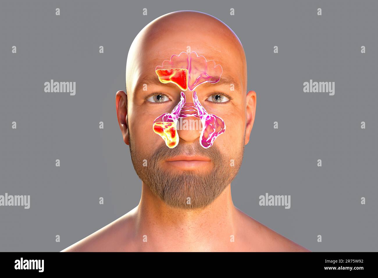 Infection sinusale ou sinusite illustration informatique Les sinus Infection sinusale ou sinusite illustration informatique Les sinus