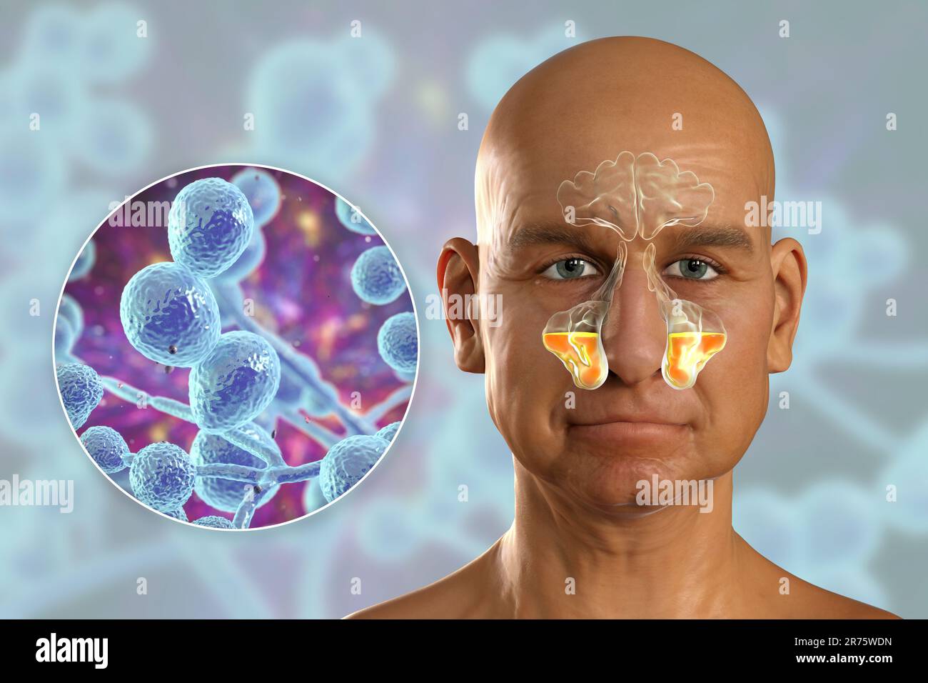 Les champignons de levure de Candida comme cause de sinusite. Illustration informatique montrant l'inflammation des sinus maxillaires et vue rapprochée des champignons de Candida. Banque D'Images