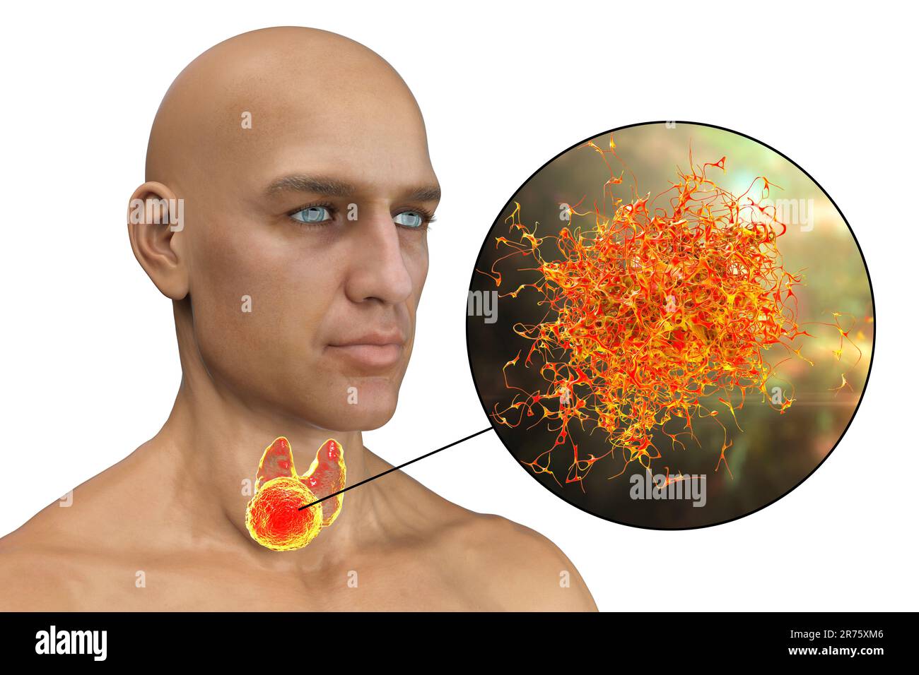Cancer de la glande thyroïde avec vue rapprochée des cellules