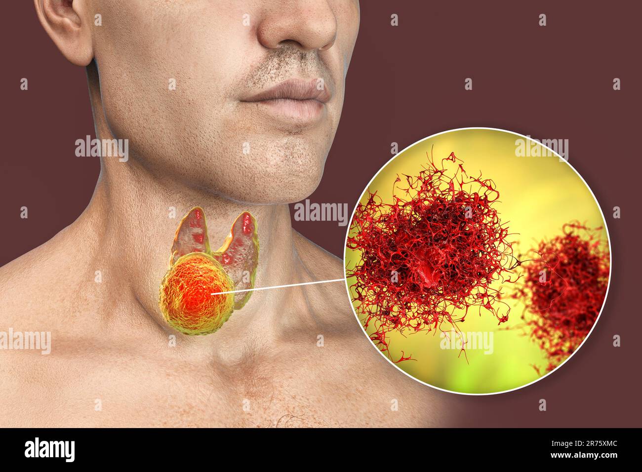 Cancer de la glande thyroïde avec vue rapprochée des cellules