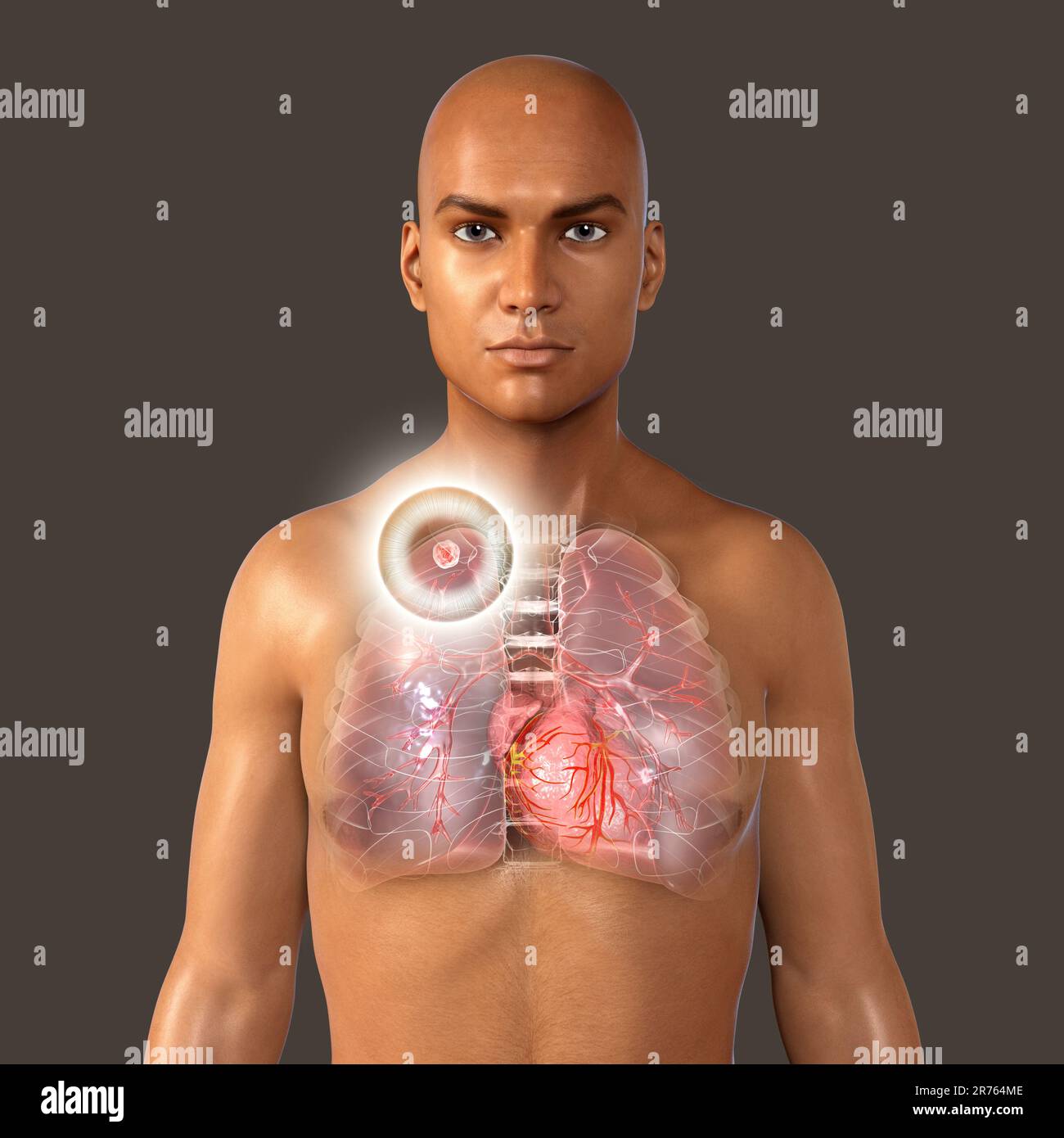 Tuberculose-infection secondaire. Illustration d'ordinateur solide de petite taille masse nodulaire situé dans le lobe supérieur du poumon droit près de l'apex pulmonaire. Banque D'Images