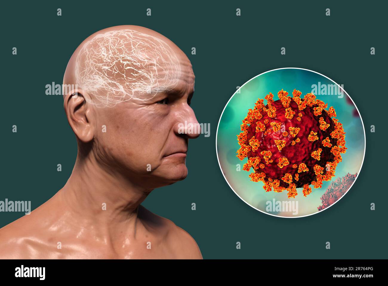 Covid-19 et la démence. Séquelles neuropsychiatriques de Covid-19, illustration informatique conceptuelle. Étiologie infectieuse de la démence. Une personne âgée avec Banque D'Images