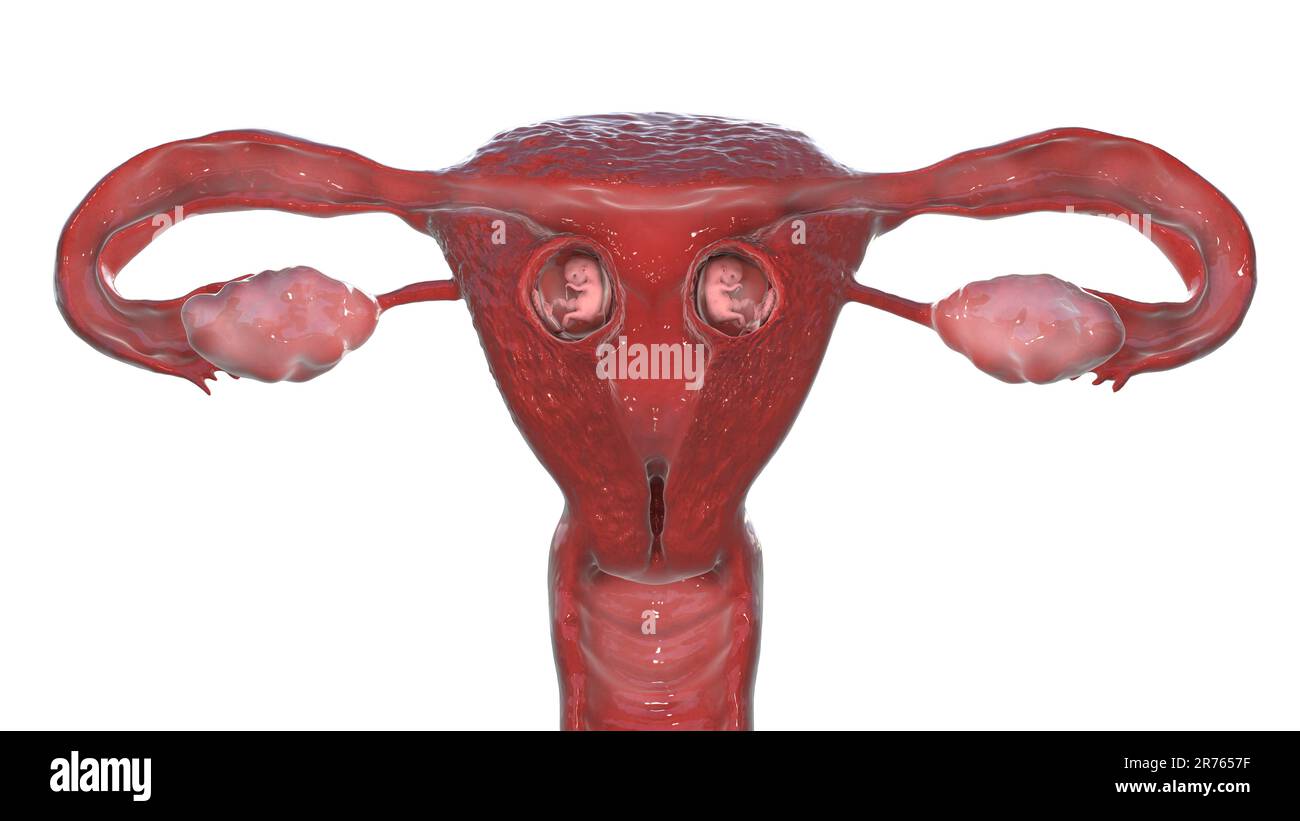 Grossesse multiple. Des jumeaux dizygotes se développent dans l'utérus séparément. Semaine 8. Banque D'Images