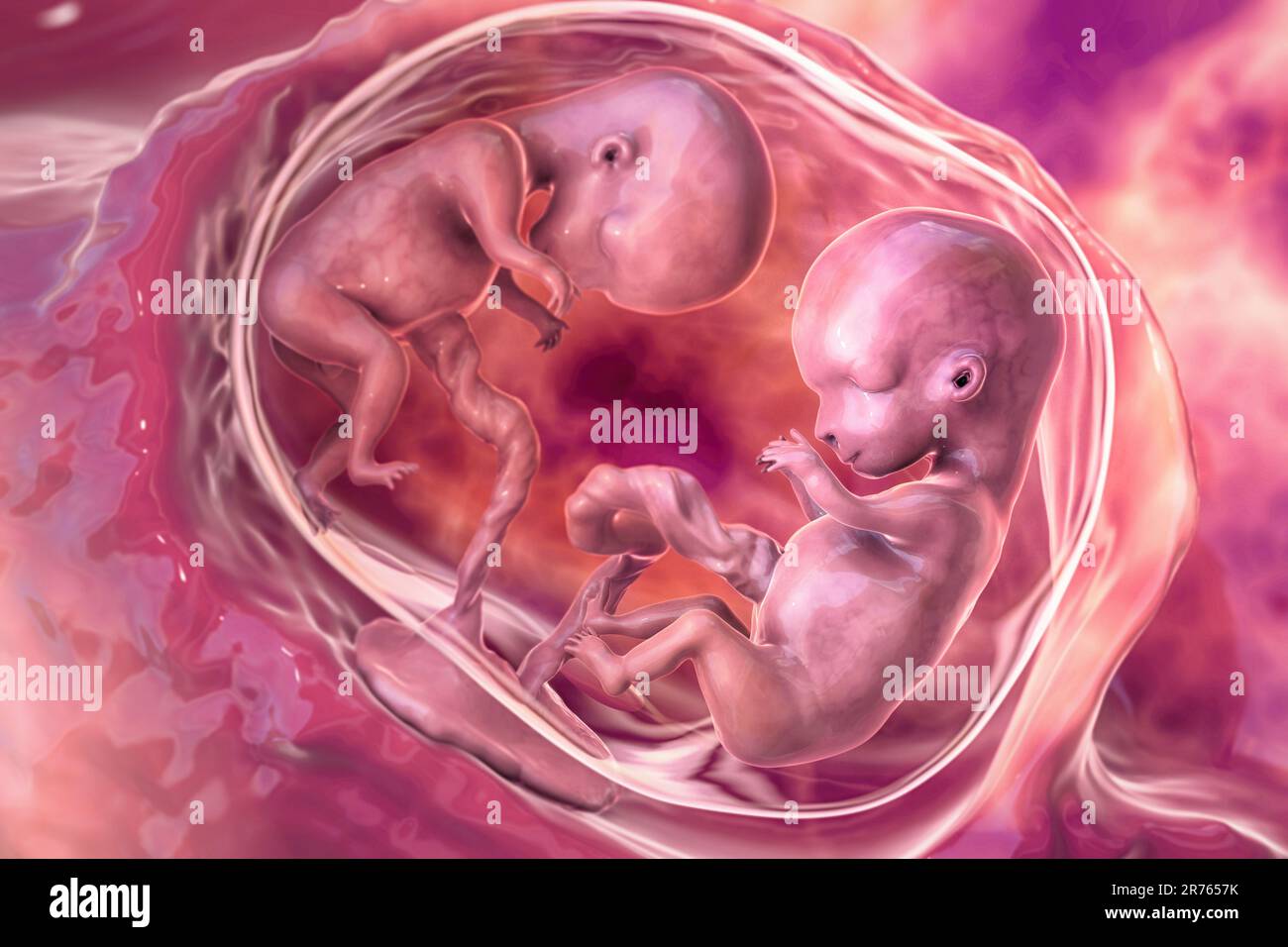 Grossesse multiple, illustration. Jumeaux monozygotes dans l'utérus partageant le même placenta. Période foetale précoce, semaine 8 - semaine 16. Banque D'Images