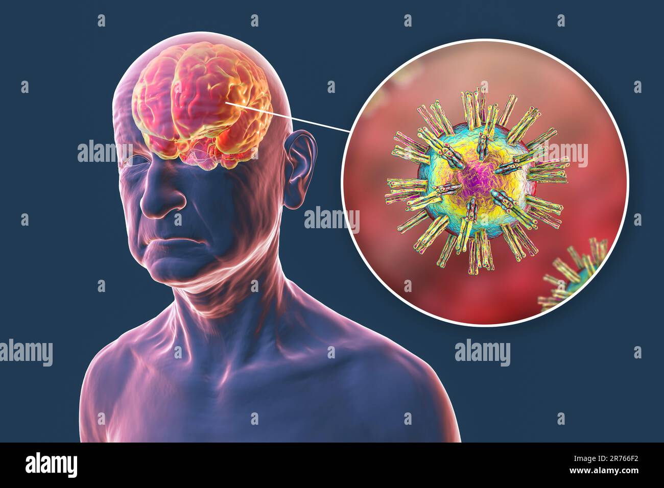 Étiologie infectieuse de la démence. Illustration informatique conceptuelle montrant une personne âgée atteinte de la maladie d'Alzheimer, troubles progressifs du cerveau Banque D'Images