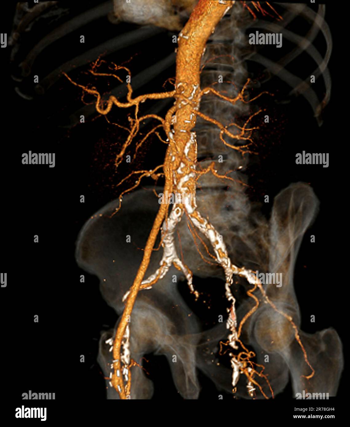 Scanner à angiographie par tomodensitométrie (CT) 3D de couleur et