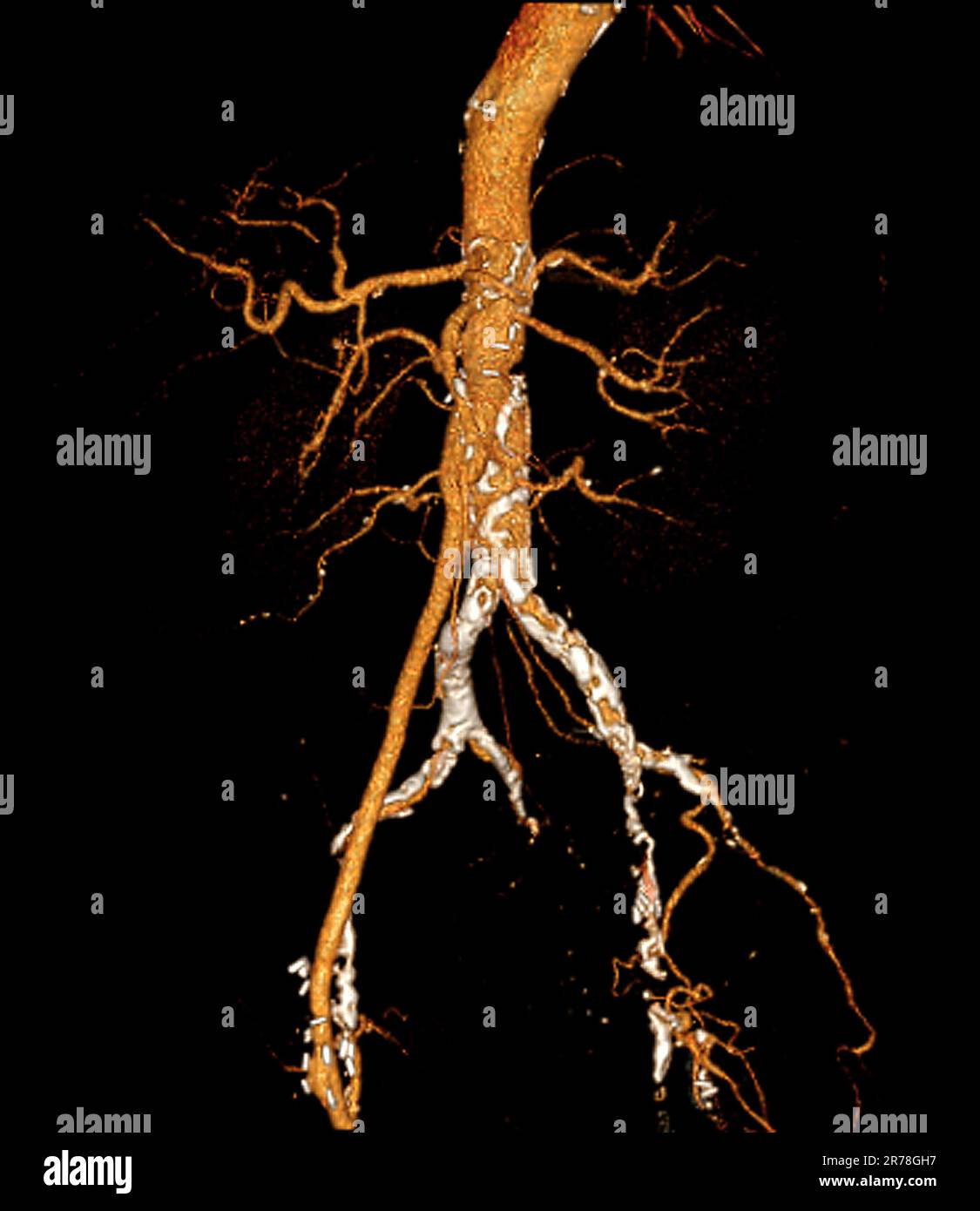 Acquisition d'angiographie par tomodensitométrie (CT) colorée en 3D