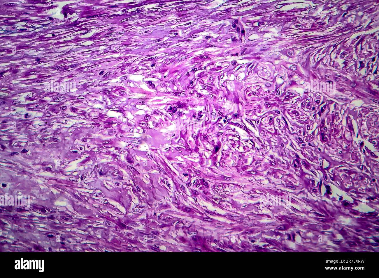 Les fibromes utérins. La lumière microphotographie (LM) d