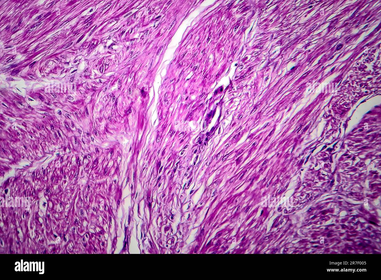 Les fibromes utérins. La lumière microphotographie (LM) d