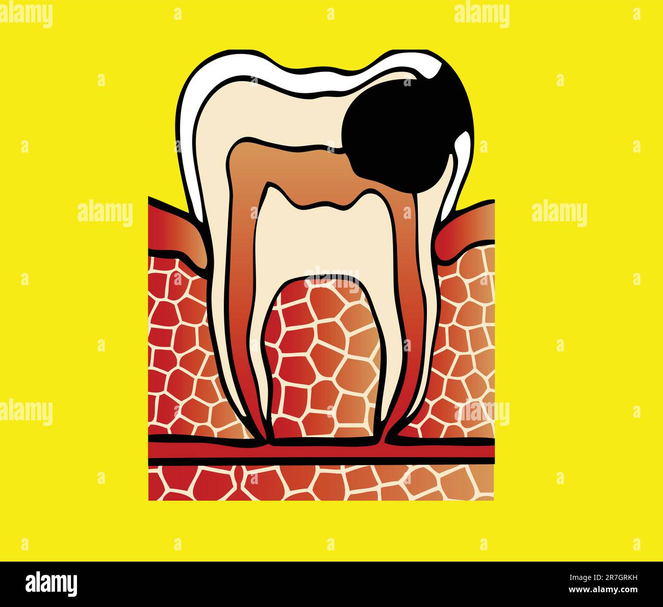 symptômes illustration du vecteur de cavité dentaire Illustration de Vecteur