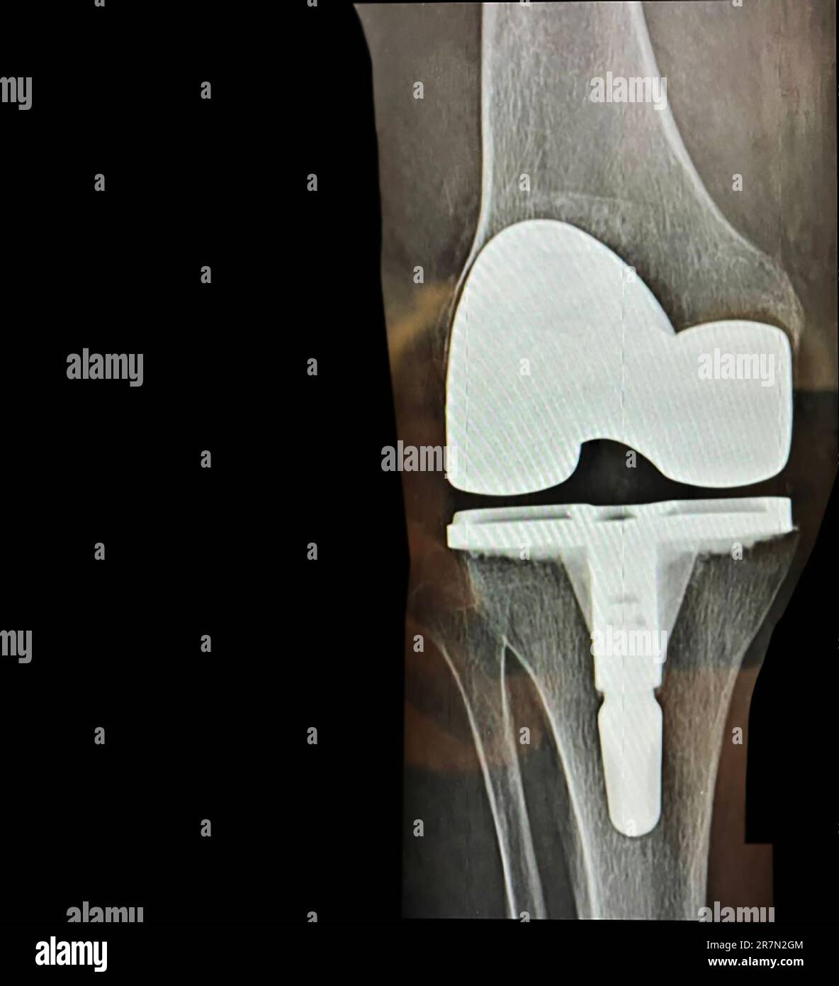 Une arthroplastie totale du genou chez la femme Banque D'Images