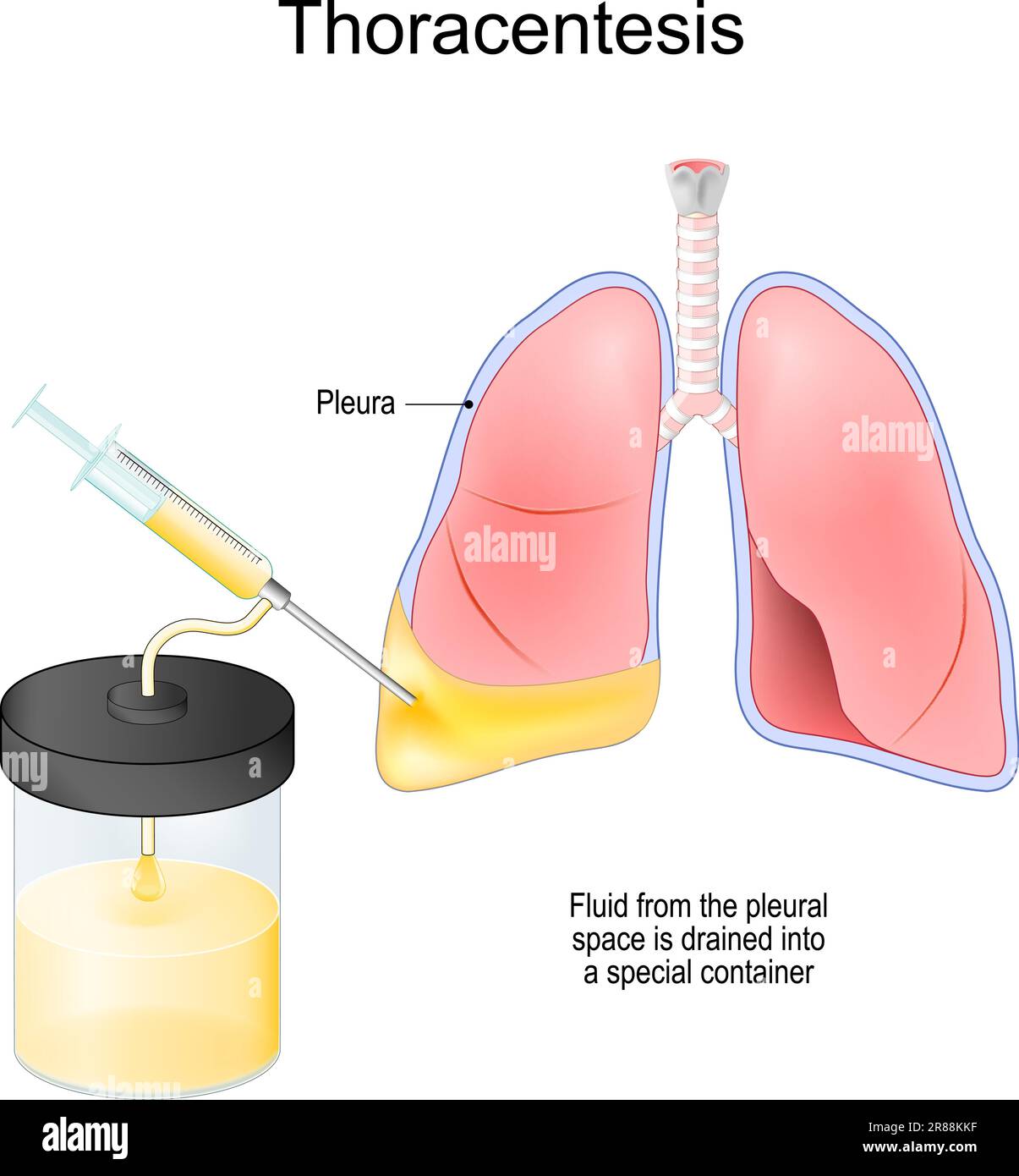 Thoracentèse. La thoracocentèse est une procédure médicale invasive visant à éliminer le liquide ou l'air de l'espace pleural pour le diagnostic ou le traitement. Seringue Illustration de Vecteur