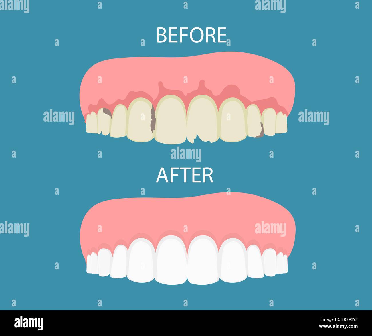 Traitement dentaire dentaire sur . Avant et après, le blanchiment de soins  buccaux concept. Nettoyage en profondeur, nettoyage des dents.  illustration. vecteur. plat Image Vectorielle Stock - Alamy