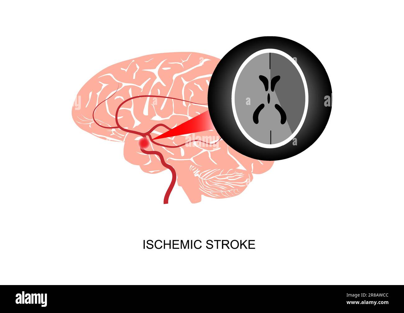 Illustration d'un infarctus cérébral ou d'un accident vasculaire cérébral ischémique et imagerie de l'acquisition CT . Illustration de Vecteur