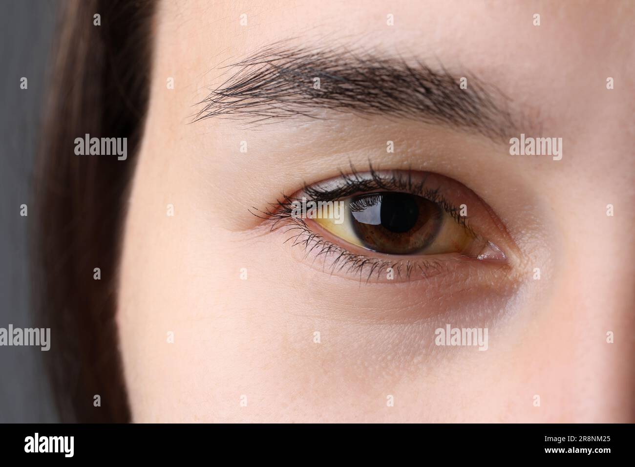 Femme avec des yeux jaunes sur fond gris, gros plan. Symptôme de l'hépatite Banque D'Images