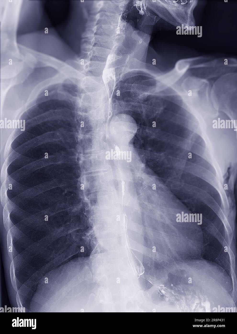 Examen de l'étude de baryum Swallow diagnostic de Barrett examen du tractus gastro-intestinal GERD série ulcères difficulté procédure pharynx UGI gorge traitement de l'intestin par fluoroscopie dev Banque D'Images