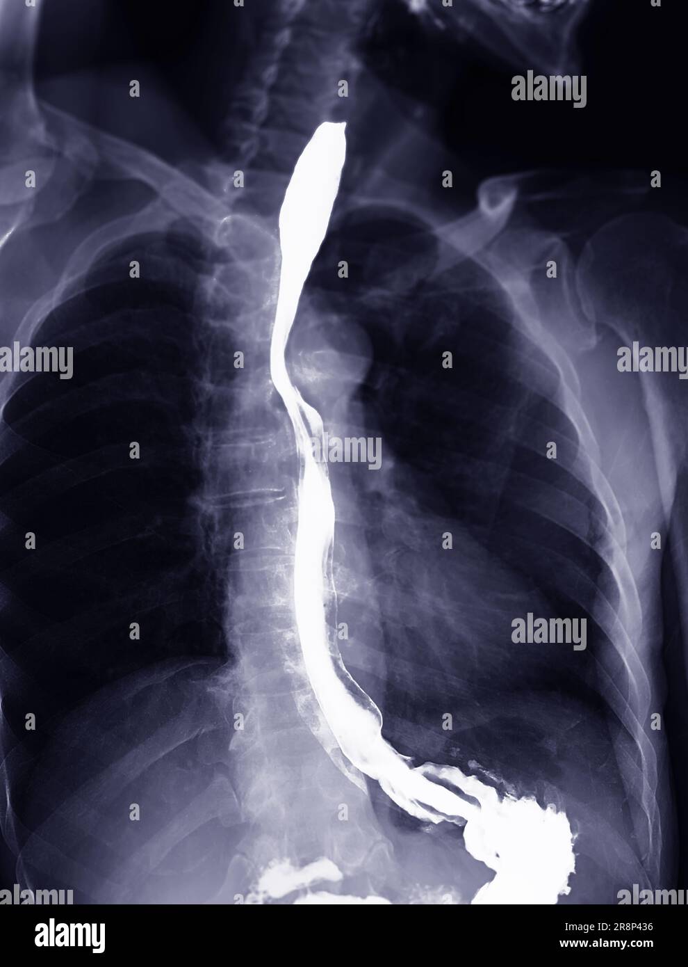 Examen de l'étude de baryum Swallow diagnostic de Barrett examen du tractus gastro-intestinal GERD série ulcères difficulté procédure pharynx UGI gorge traitement de l'intestin par fluoroscopie dev Banque D'Images