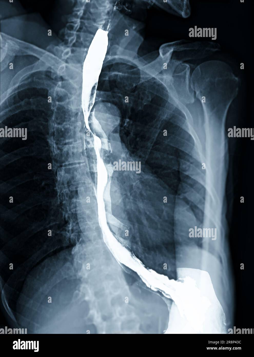 Examen de l'étude de baryum Swallow diagnostic de Barrett examen du tractus gastro-intestinal GERD série ulcères difficulté procédure pharynx UGI gorge traitement de l'intestin par fluoroscopie dev Banque D'Images