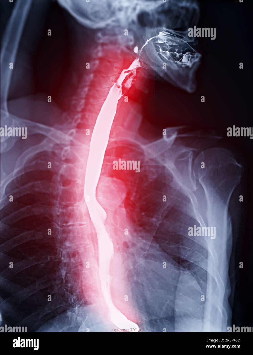 Examen de l'étude de baryum Swallow diagnostic de Barrett examen du tractus gastro-intestinal GERD série ulcères difficulté procédure pharynx UGI gorge traitement de l'intestin par fluoroscopie dev Banque D'Images