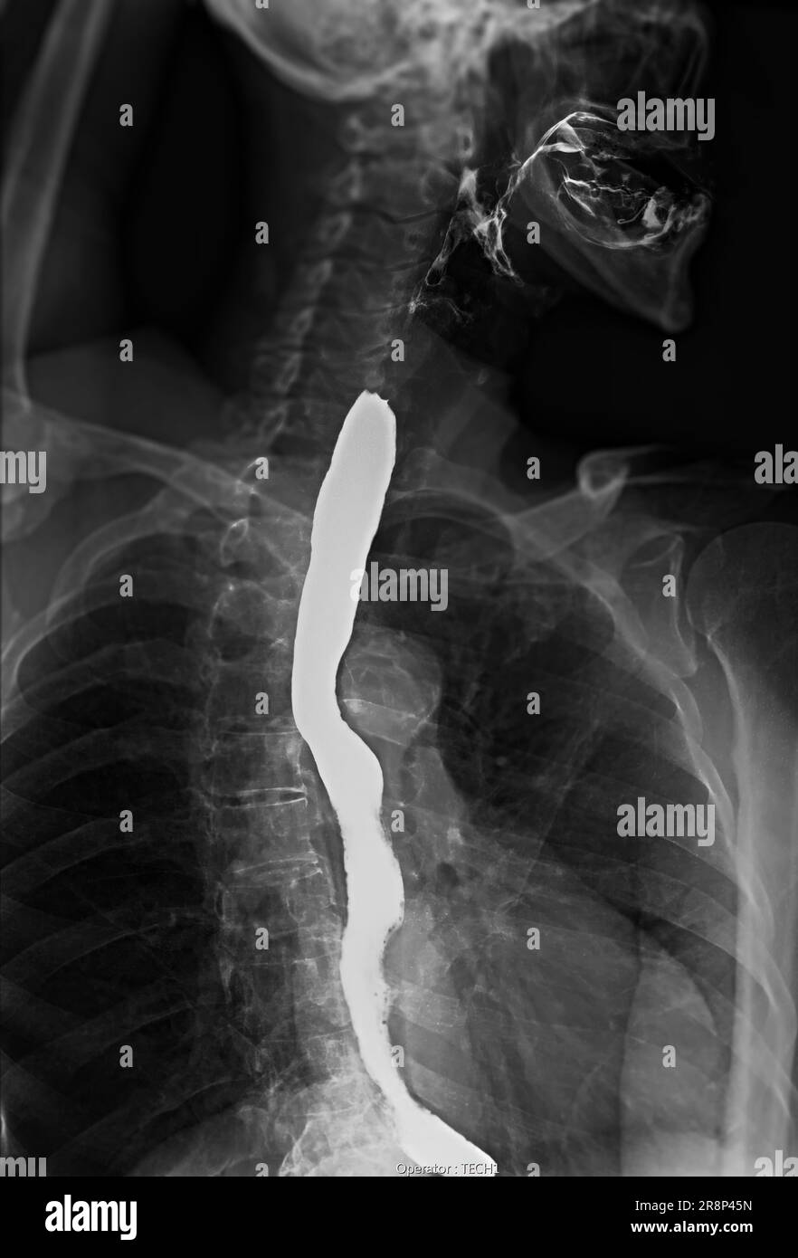 Examen de l'étude de baryum Swallow diagnostic de Barrett examen du tractus gastro-intestinal GERD série ulcères difficulté procédure pharynx UGI gorge traitement de l'intestin par fluoroscopie dev Banque D'Images