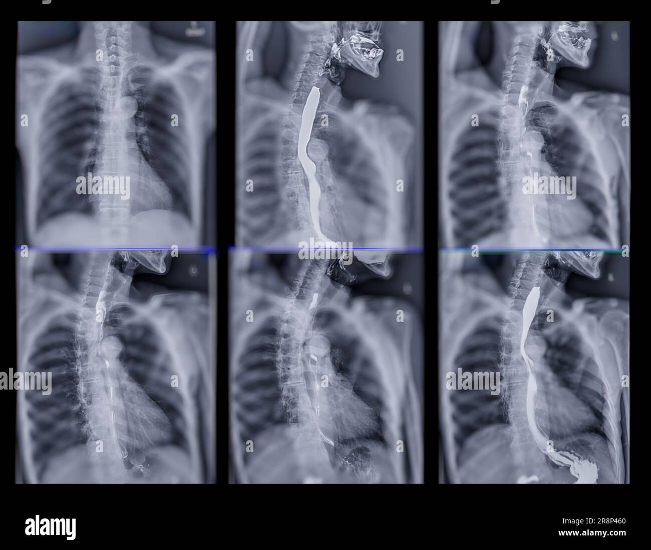 Examen de l'étude de baryum Swallow diagnostic de Barrett examen du tractus gastro-intestinal GERD série ulcères difficulté procédure pharynx UGI gorge traitement de l'intestin par fluoroscopie dev Banque D'Images