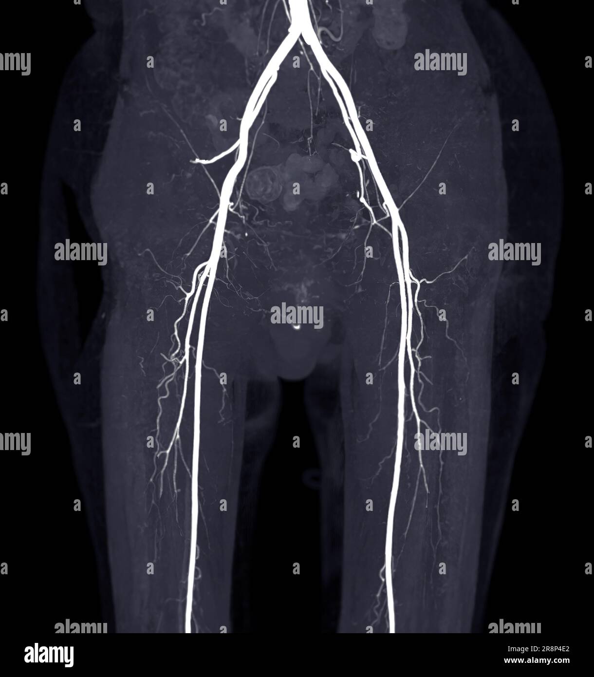 Image de l'artère fémorale CTA de l'artère fémorale pour diagnostic de maladie artérielle périphérique aiguë ou chronique. Banque D'Images