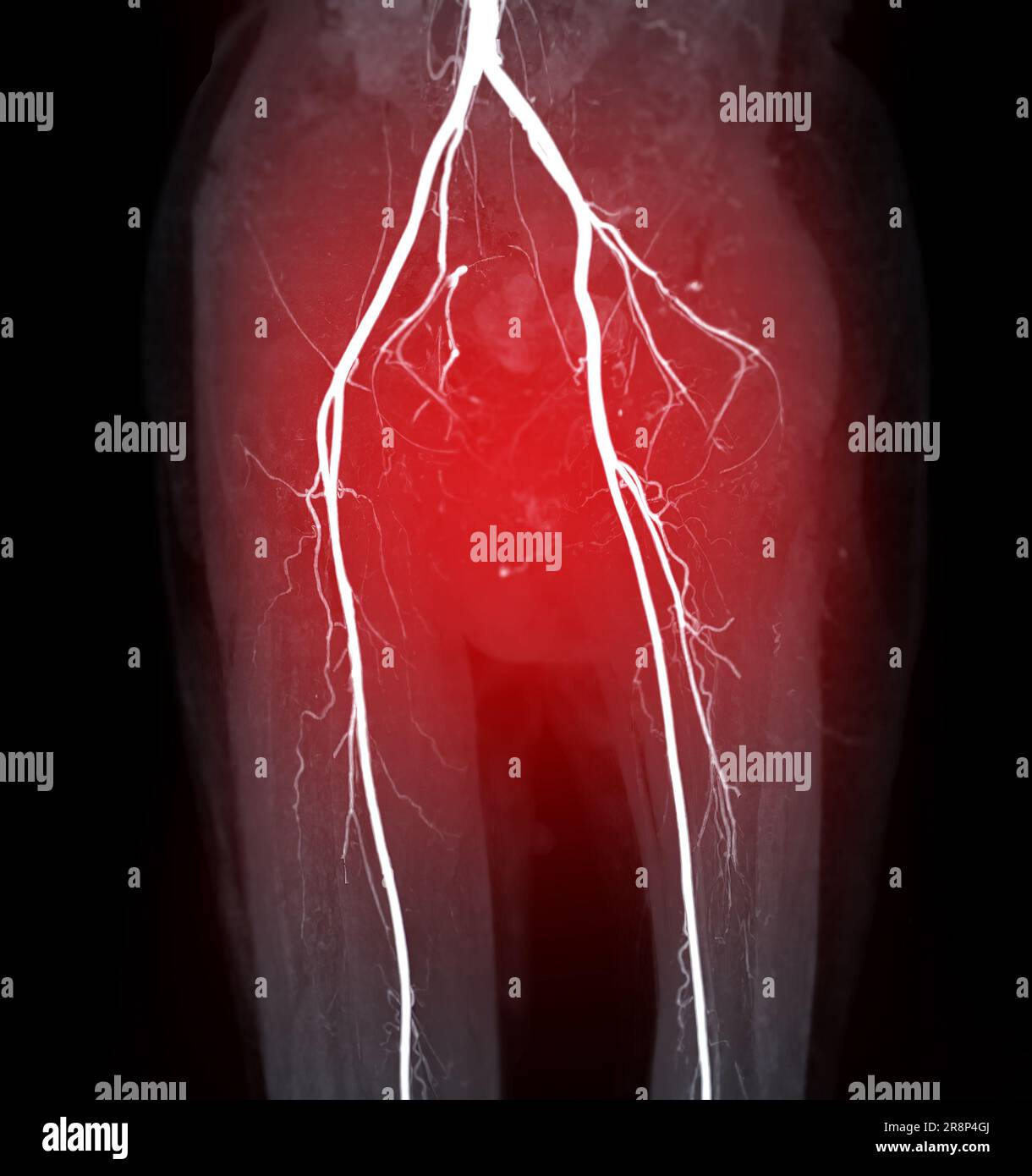 Image de l'artère fémorale CTA de l'artère fémorale pour diagnostic de maladie artérielle périphérique aiguë ou chronique. Banque D'Images